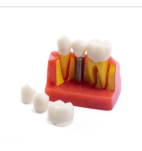 Macromodelo Implante Dental